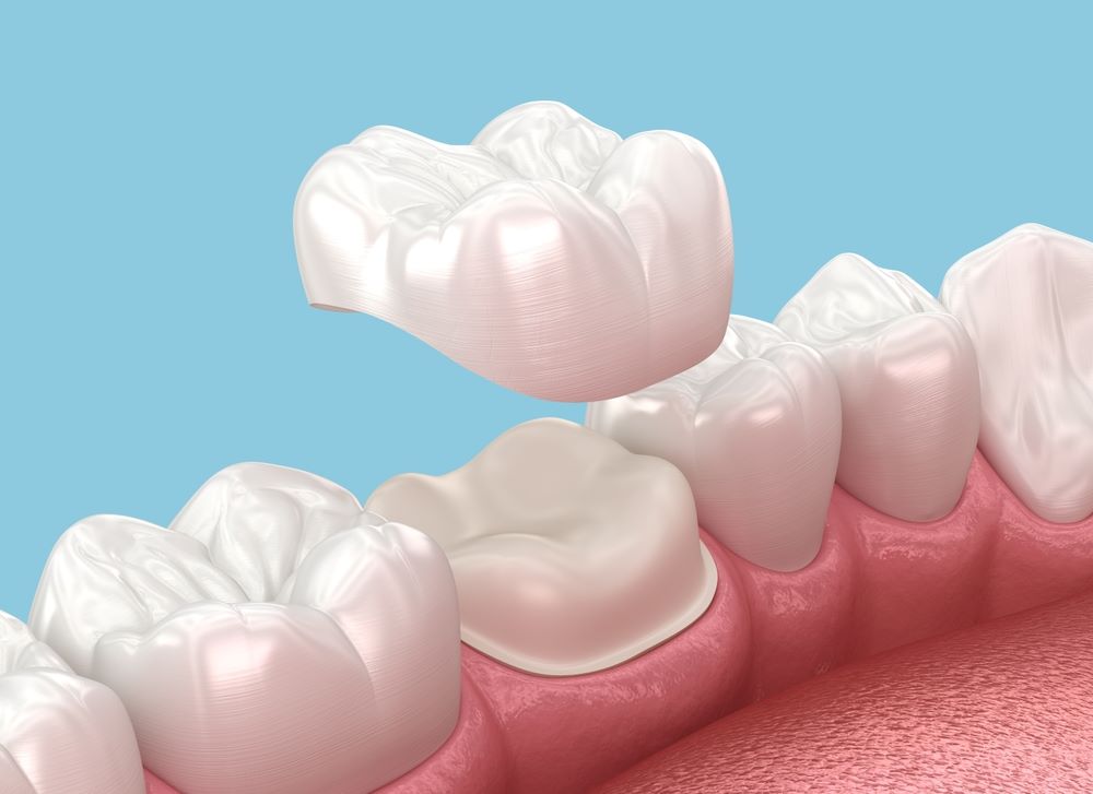Dental Crown and Bridge 1