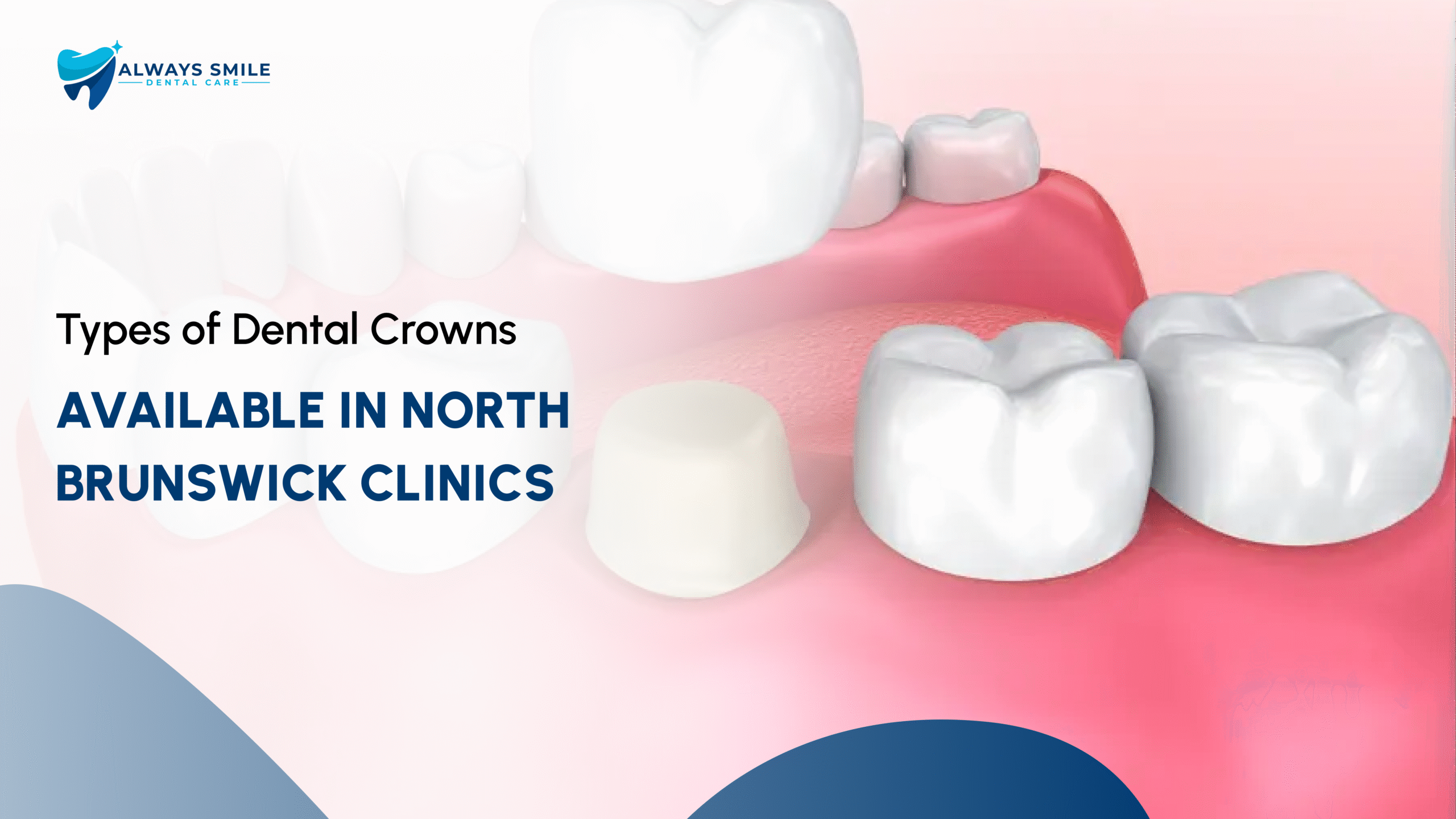 Types of Dental Crowns Available in North Brunswick Clinics
